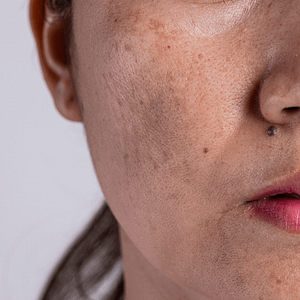 Skin Pigmentation and Sun Damage: What causes it and what should you do about it?