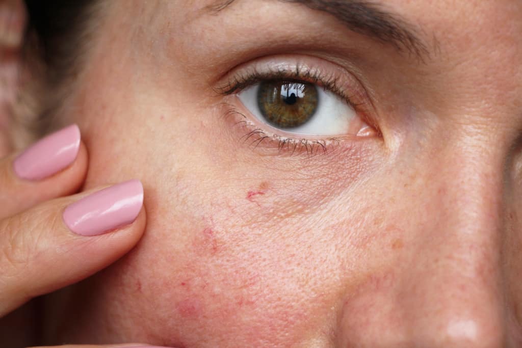 Rosacea And Facial Redness Bloom Clinic
