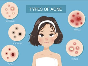 Adult acne & breakouts