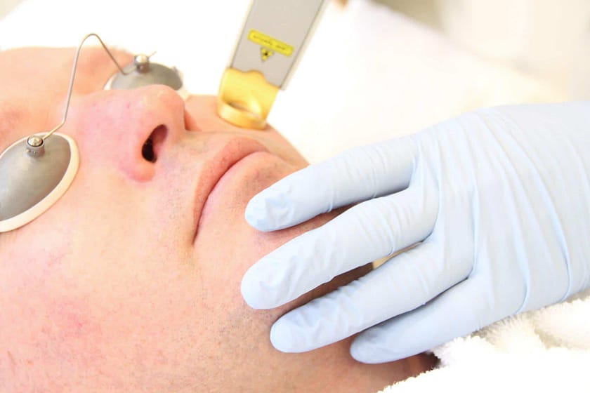 How to get rid of Facial Spider Veins with Laser