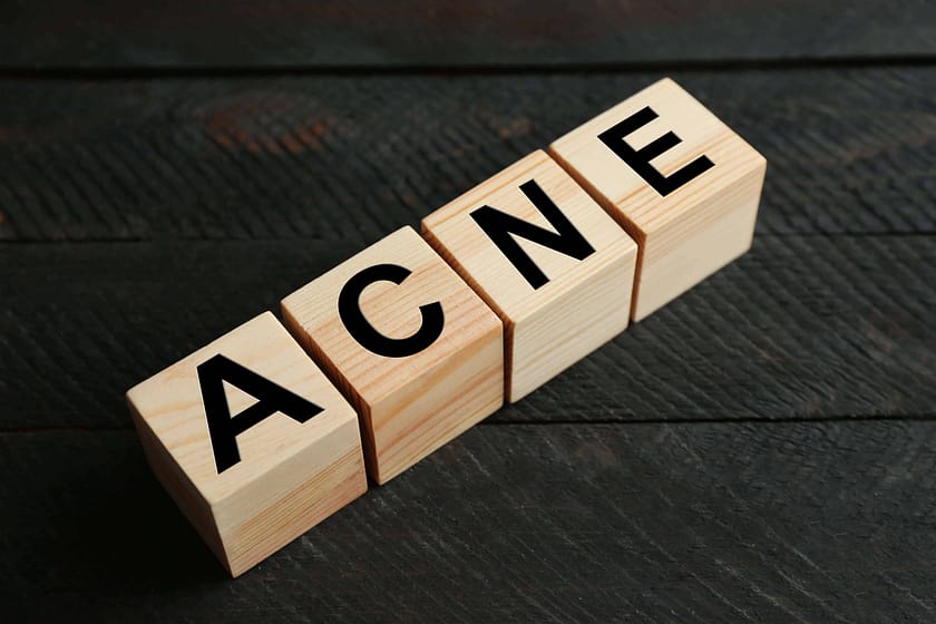 HOW TO TREAT ADULT ACNE