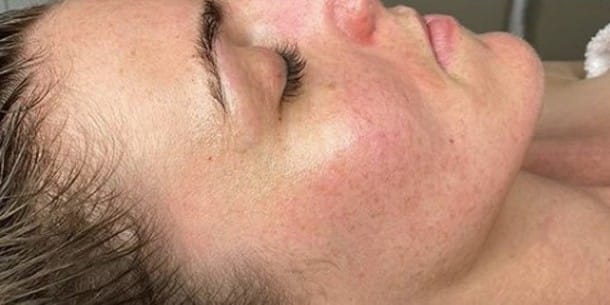 Microdermabrasion-after