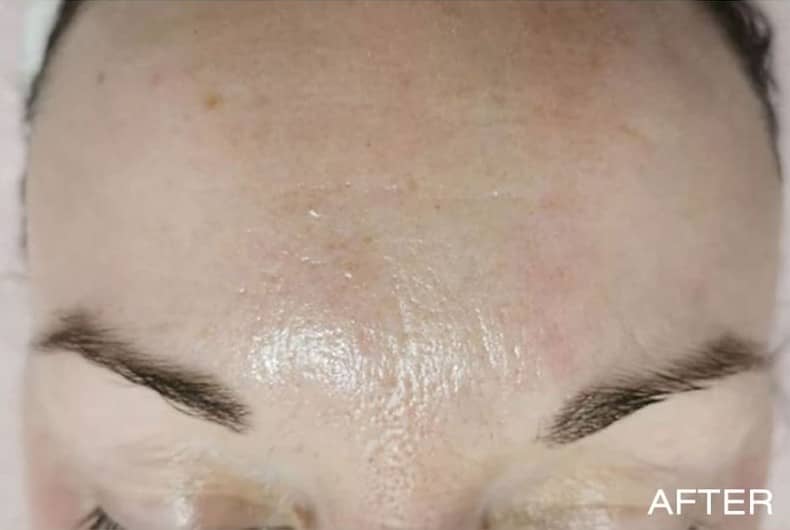 Microdermabrasion-example-after