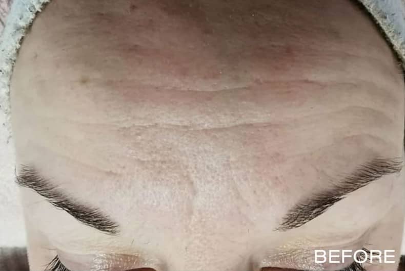 Microdermabrasion-example-before